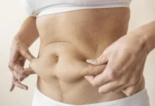 Tummy Tuck in Dubai