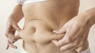 Tummy Tuck in Dubai