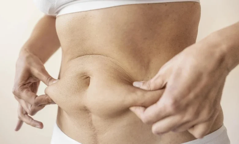 Tummy Tuck in Dubai